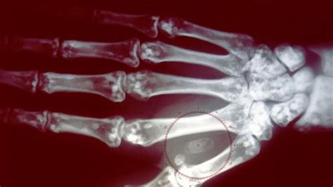 rfid chip en humanos|Cómo funcionan los microchips que se implantan bajo la piel y.